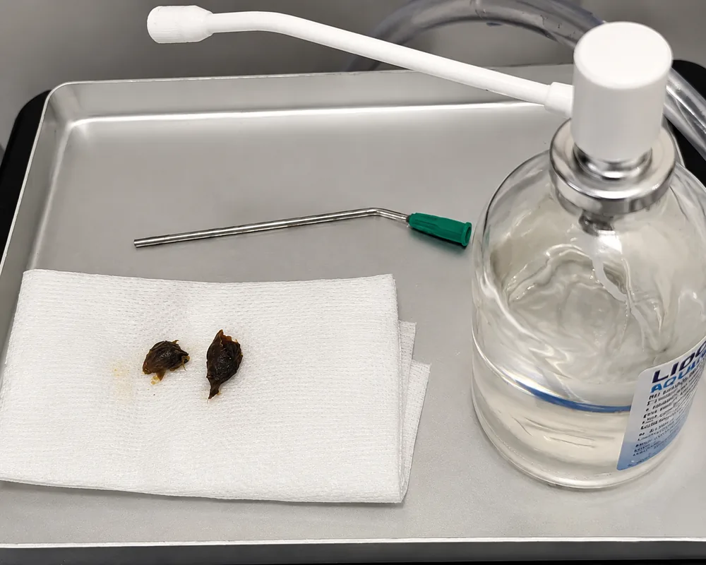 Earwax plugs removed during the ENT consultation