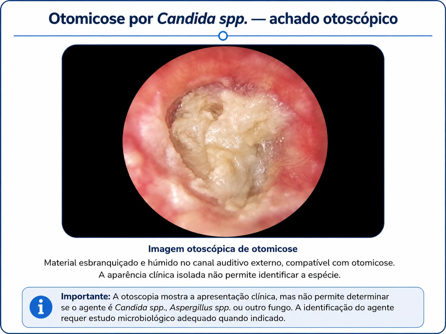 Otomycosis with whitish and moist material in the external ear canal seen on otoscopy