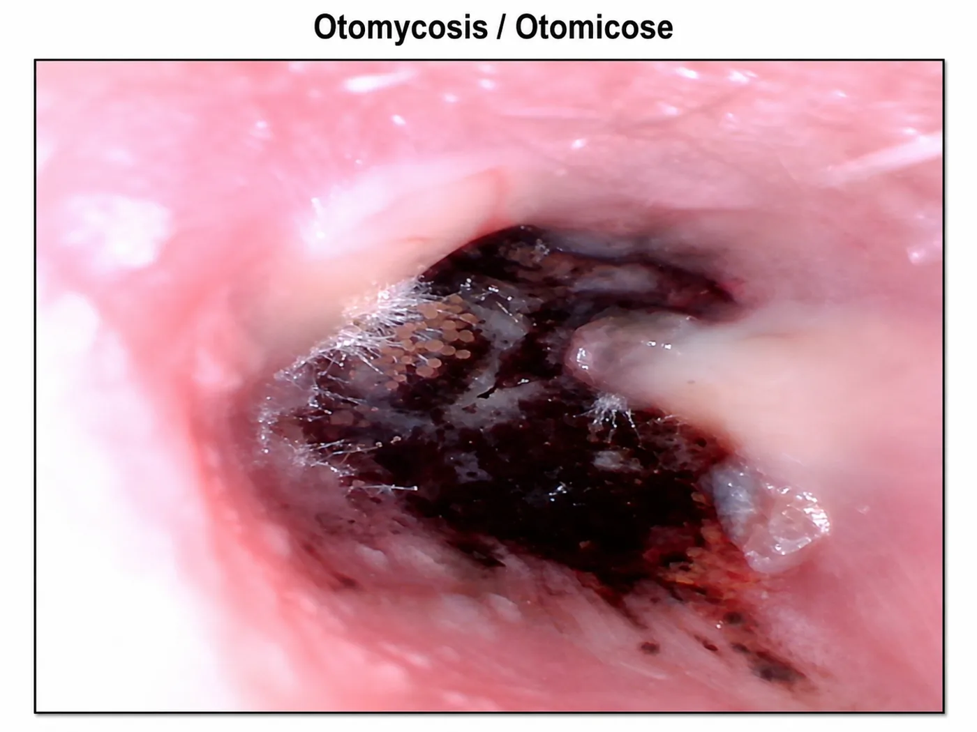 Otomycosis of the external ear canal with dark fungal debris seen on otoscopy