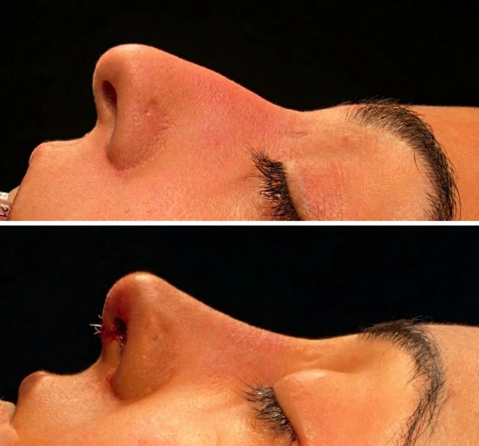 Rinoplastia — perfil nasal antes e imediatamente após a cirurgia, imagem intra-operatória do caso clínico 1