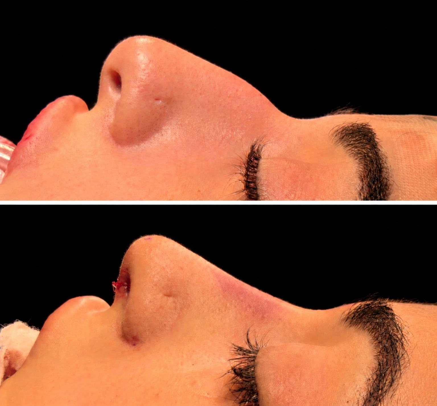 Rinoplastia — perfil nasal antes e imediatamente após a cirurgia, imagem intra-operatória do caso clínico 2